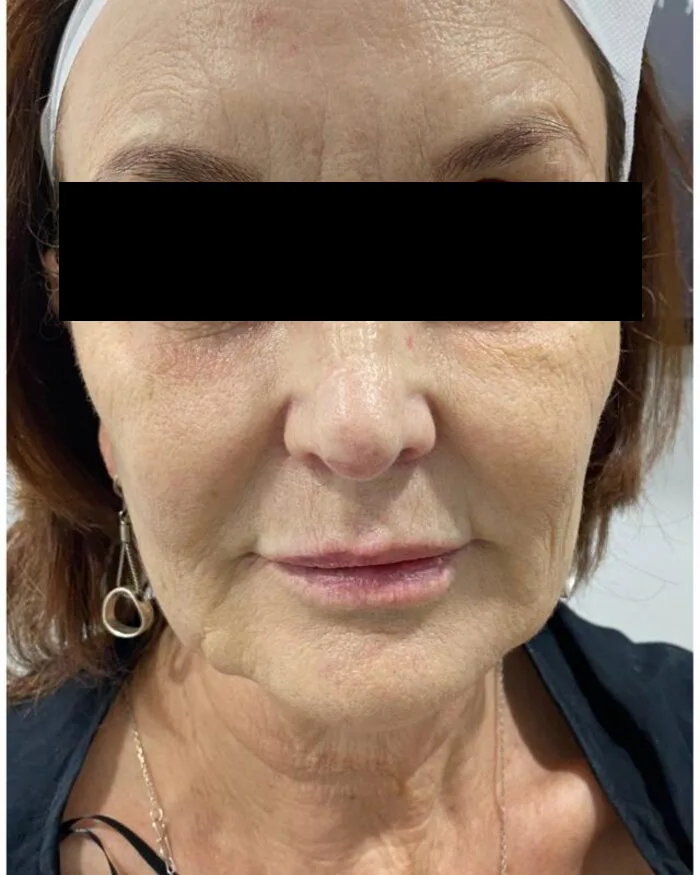 After — Fine lines & skin texture