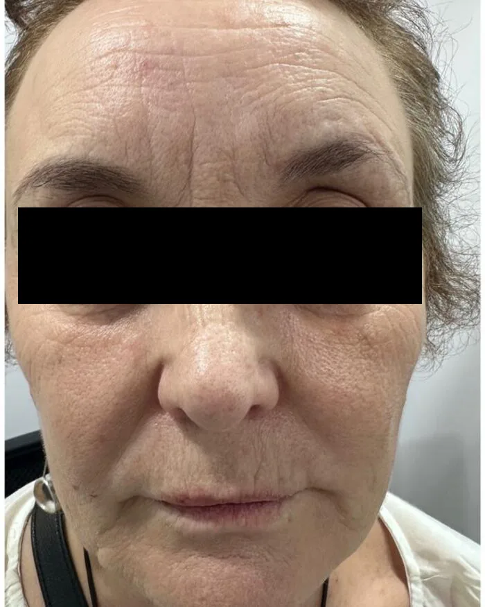 Before — Fine lines & skin texture